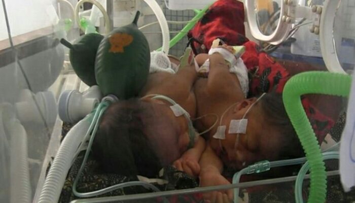 Bayi Kembar Siam Alami Dempet Perut akan di Operasi di Surabaya