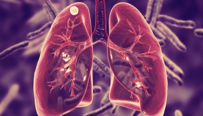 Penyebab Utama Paru-paru Basah